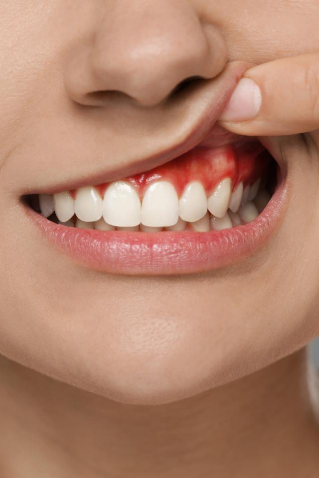 Zapalenie dziąseł – co je powoduje?