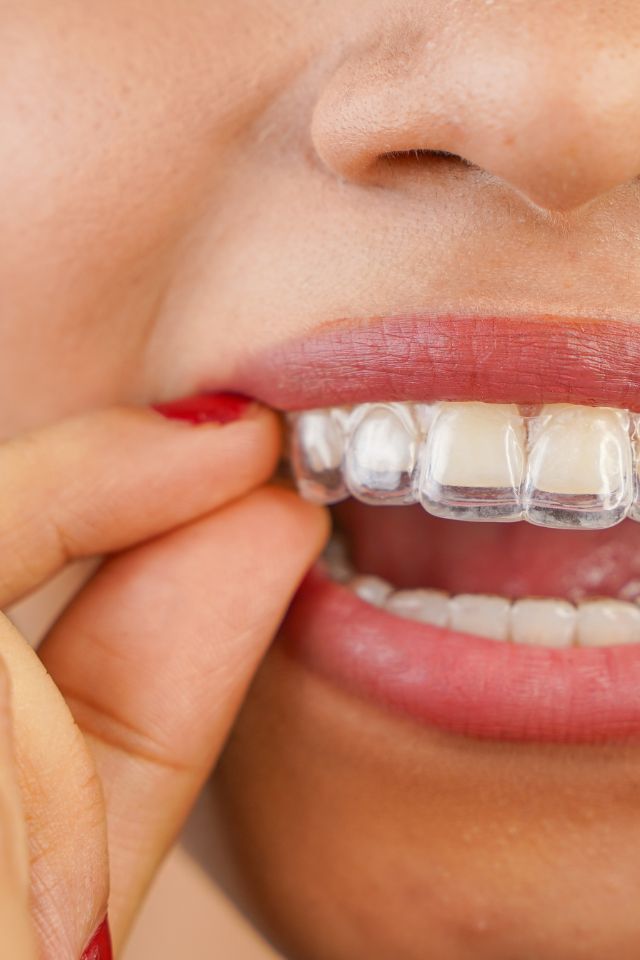 Kobieta zdejmująca nakładki ortodontyczne - jak to robić?